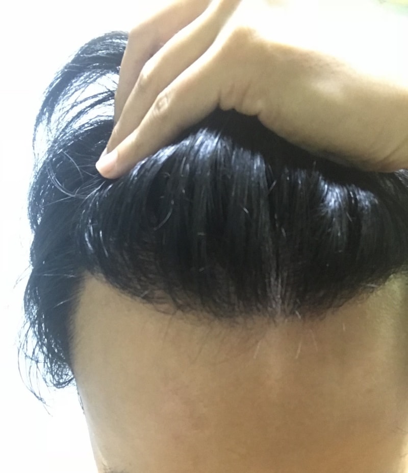 7일후 1년2개월 경과 m자 탈모 비절개
