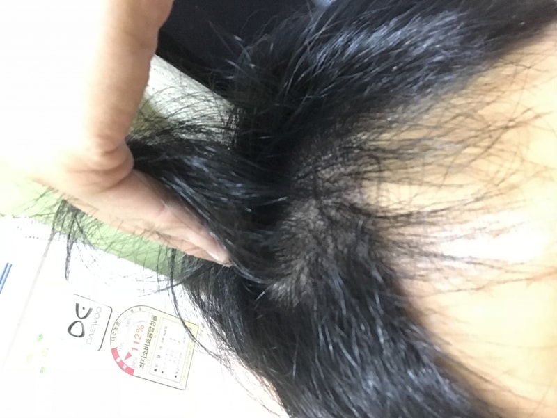5일 뒤면 모발이식 8개월차입니다