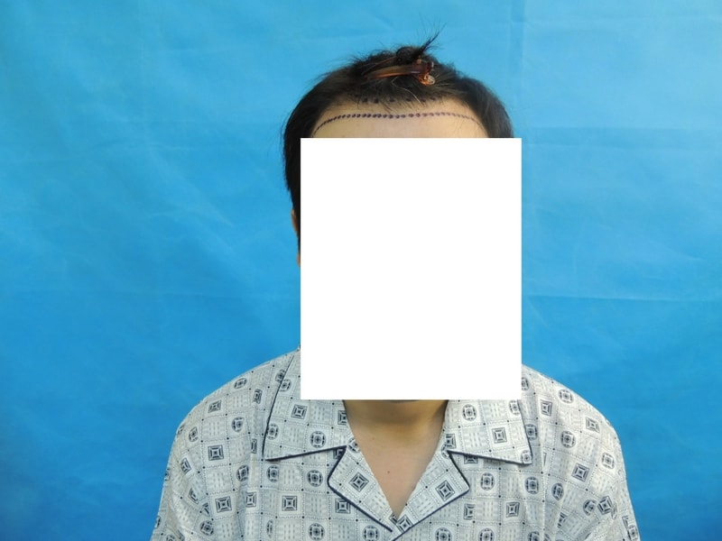 수술전 후기.jpg