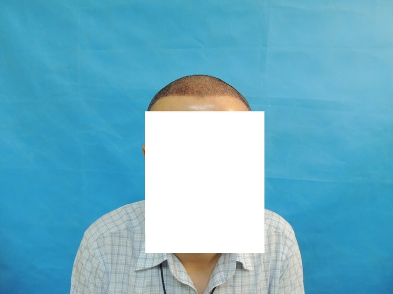 수술 1일차후기.jpg
