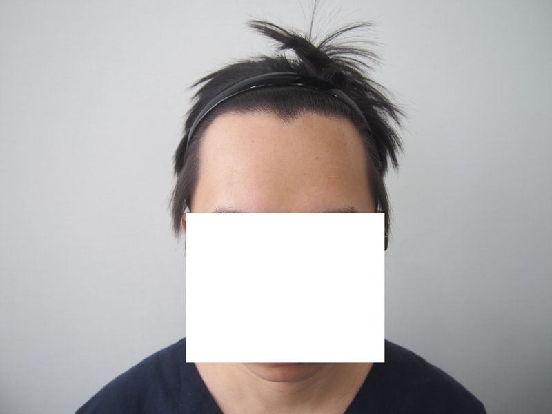 1400모낭 2900모