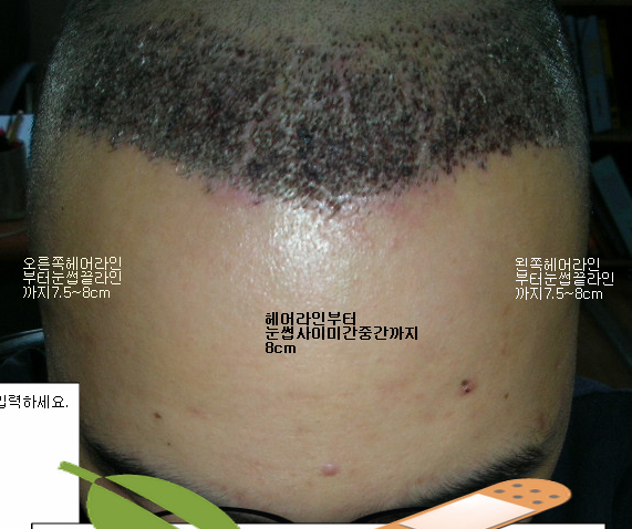 1-2수술후정면.jpg