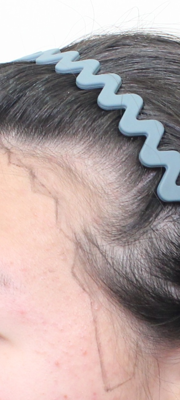 Mopro Clinic / Hairline, Sideburnt Transplantation / Day 15
