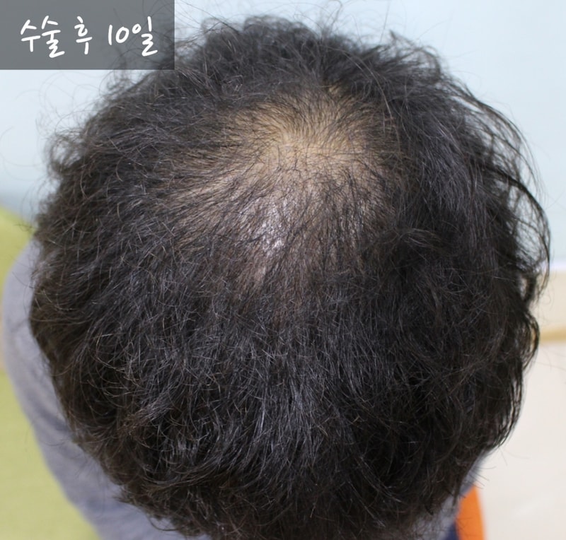 수술 후 10일.jpg