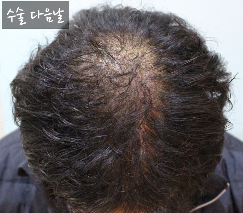 수술 다음날.jpg