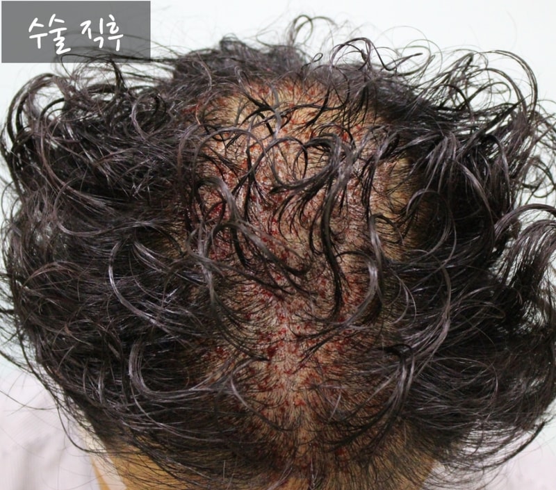 수술 직후.jpg