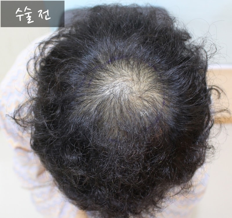 수술 전.jpg