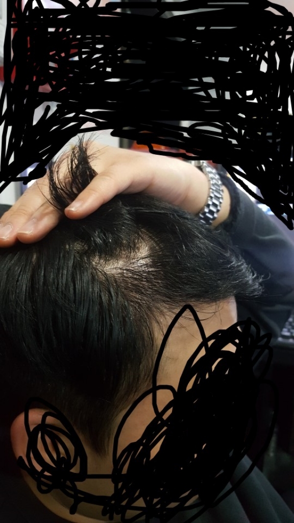 모발이식한지  6개월차 입니다  왼쪽은 좀 많이 나왓는데 오른쪽이 아직 밀도가 많이 부족하고, 휑하네요...  6개월정도에는 몇프로정도나오나요??ㅠㅠ