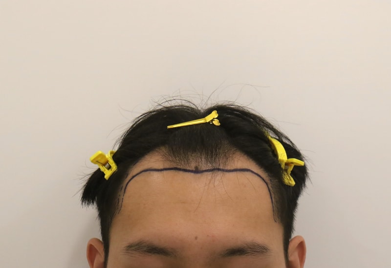 탈모3.jpg