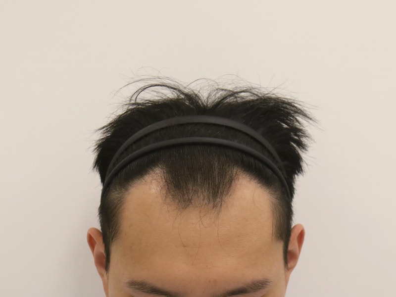 탈모2.jpg