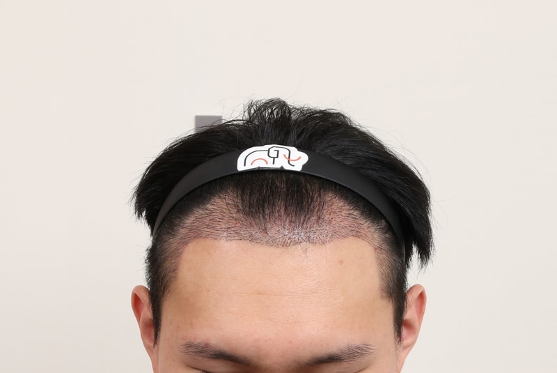 탈모6.jpg