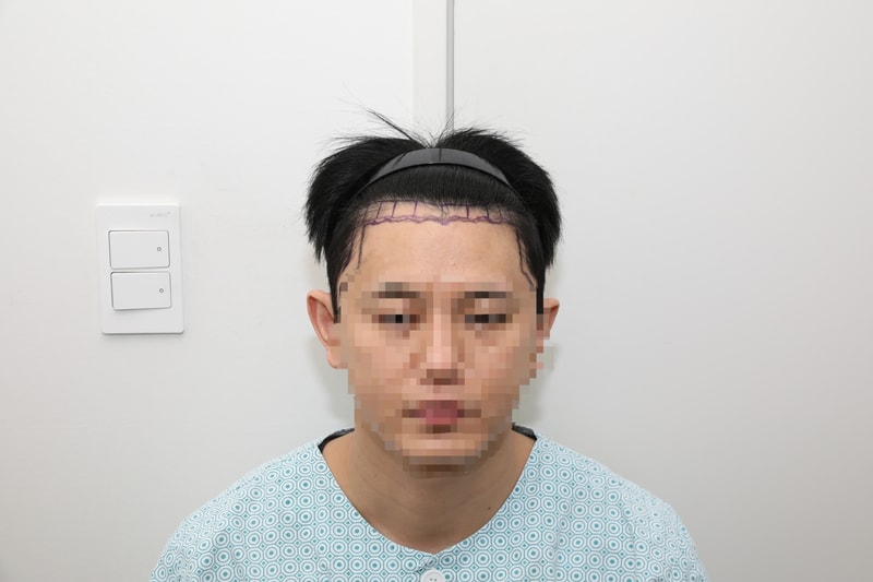 제목 : 뉴헤어 강남 절개모발이식 2000모낭 180일 6개월차 후기