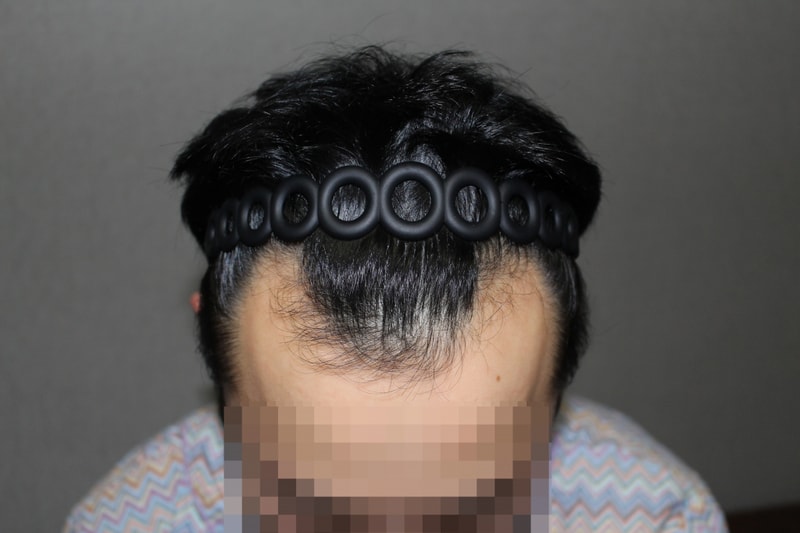 18-910214임경래__수술전 (14)2424.JPG