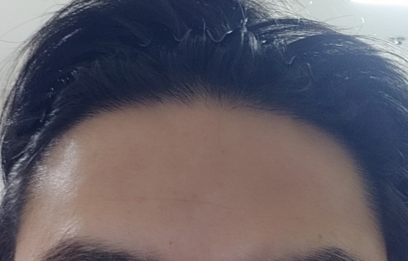 모재성 성형외과 모발이식 8개월 후기
