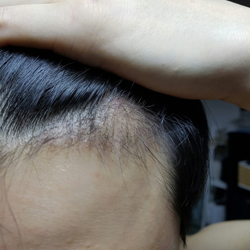 1200모낭 M자 비절개 4개월