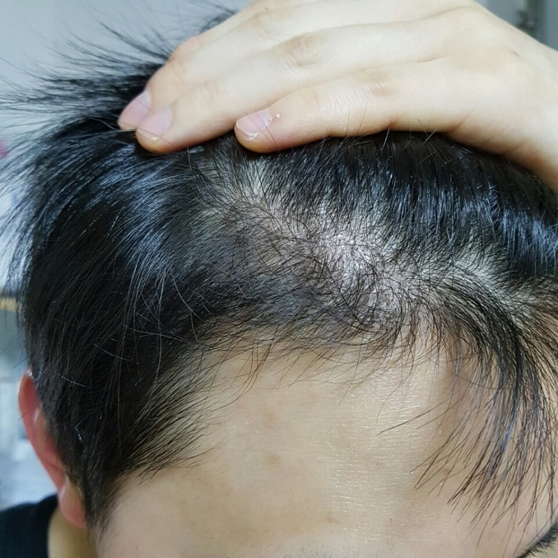 포헤어 M자이마 비절개 1200모낭 약 5개월 후기