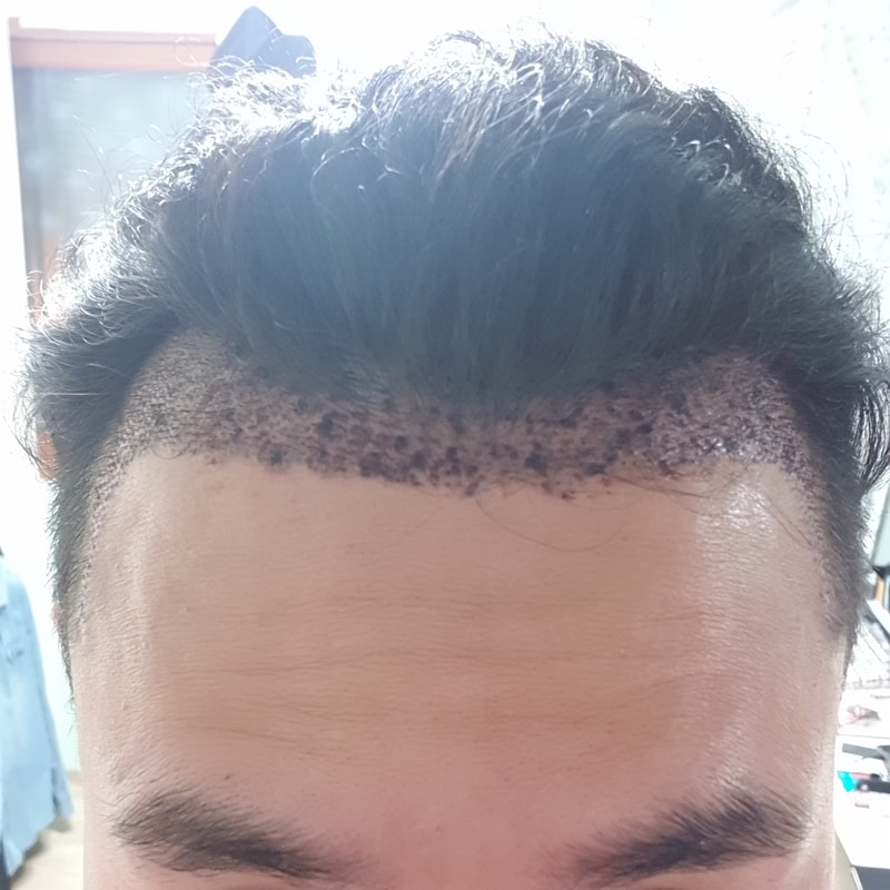 모발이식 2일차 내원해서 샴푸하고 왔습니다!