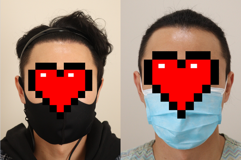 시술 후 1년(365일)이 지났습니다. 대만족 중입니다.