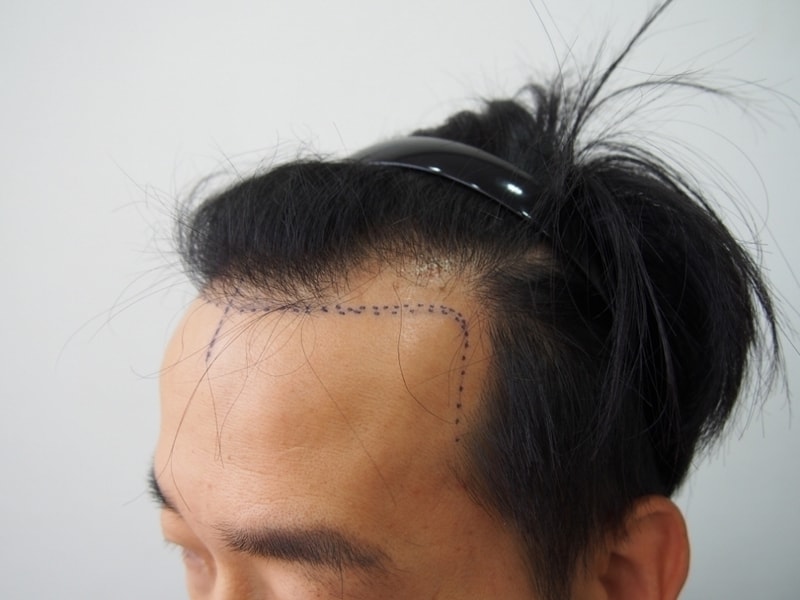 크기변환_수술전2.JPG