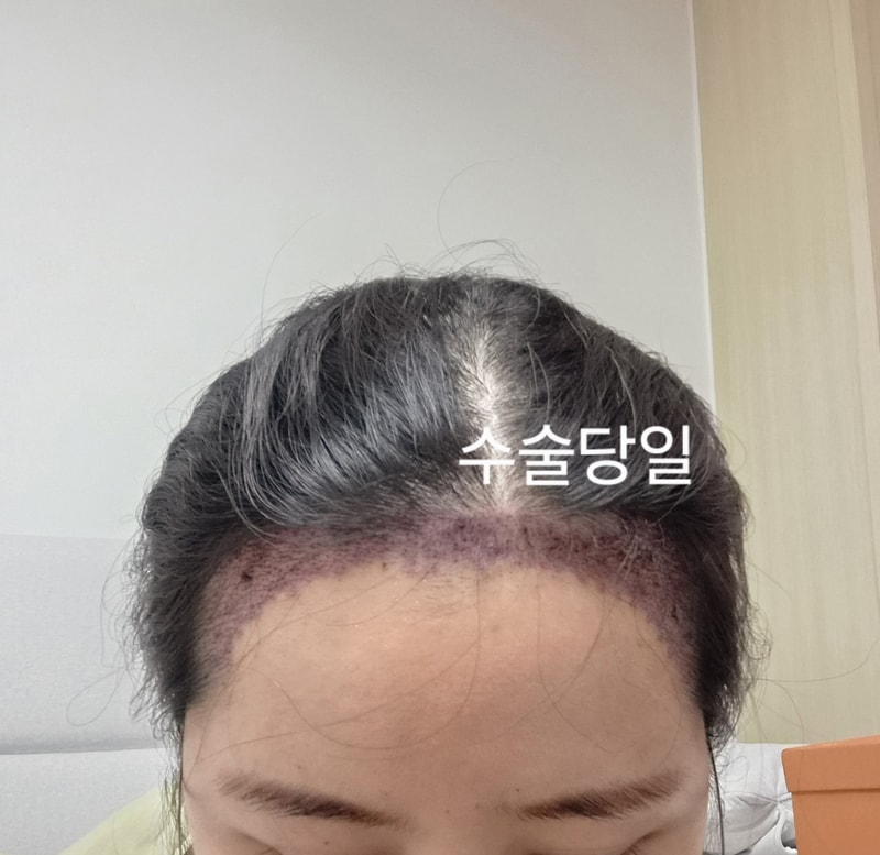 헤어라인 비절개로 알파모의원에서 수술했어요~!