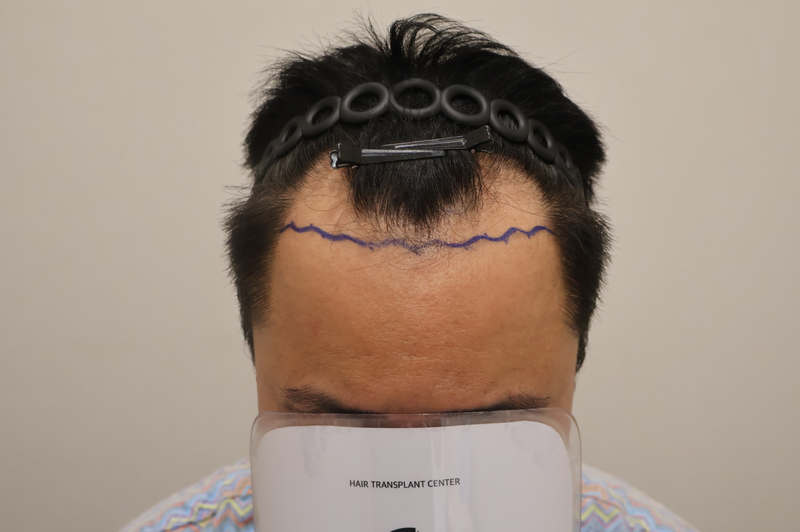 HAIRO HAIR TRANSPLANT CENTER Dongtan Non-Cutting Hair Transplant 3400 Mo 10th Day