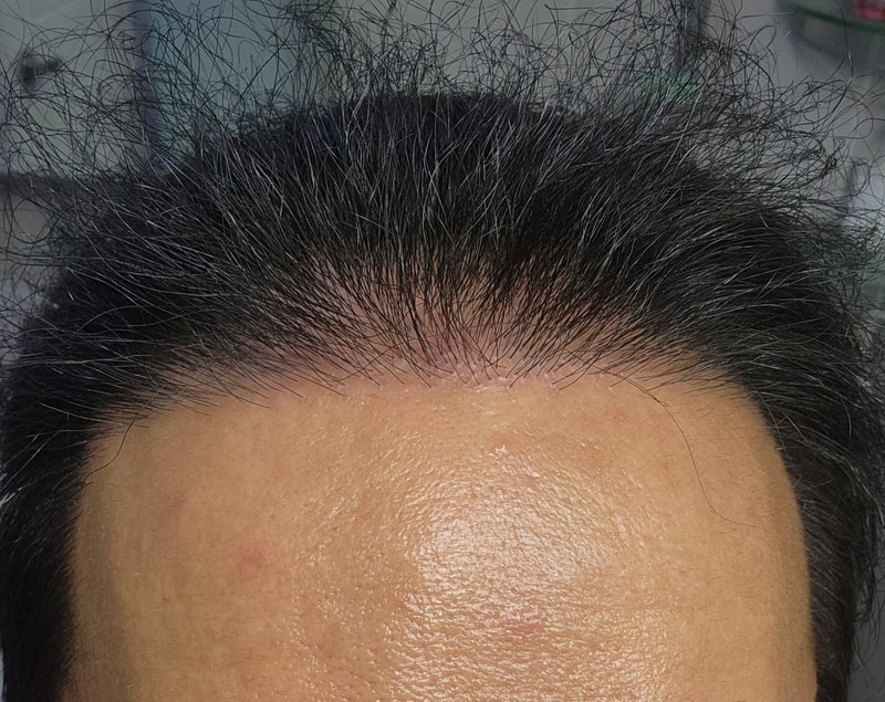 모재성 모발이식 8개월차 후기