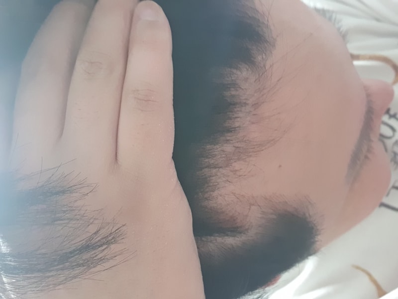 M자 비절개 모발이식 5개월차 후이