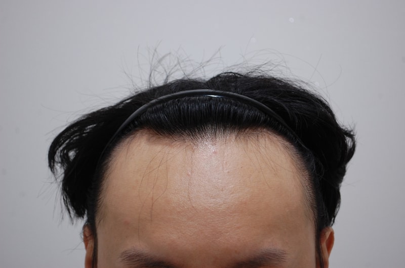 수술전 정면.JPG