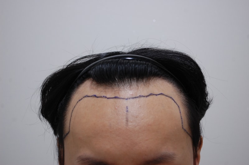 수술전 정면 디자인.JPG