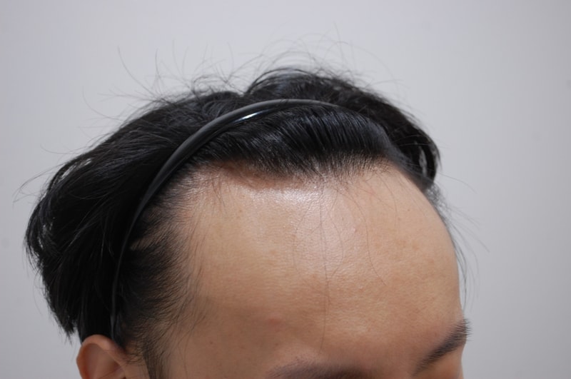 수술전 측면.JPG
