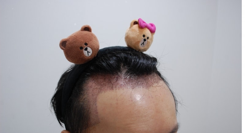 수술후 측면.JPG