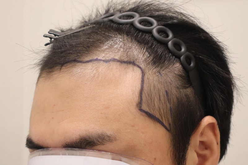 HAIRO 植毛 Dongtan切開 3800本体験談