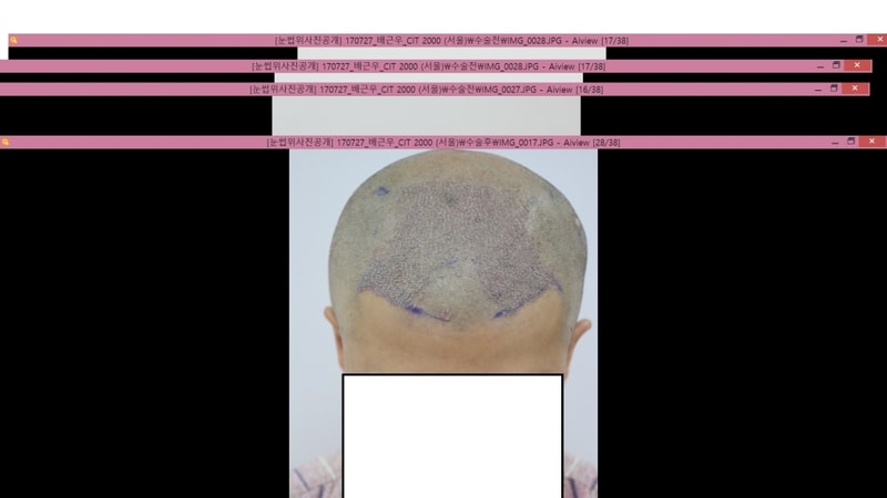 수술후 1일.png