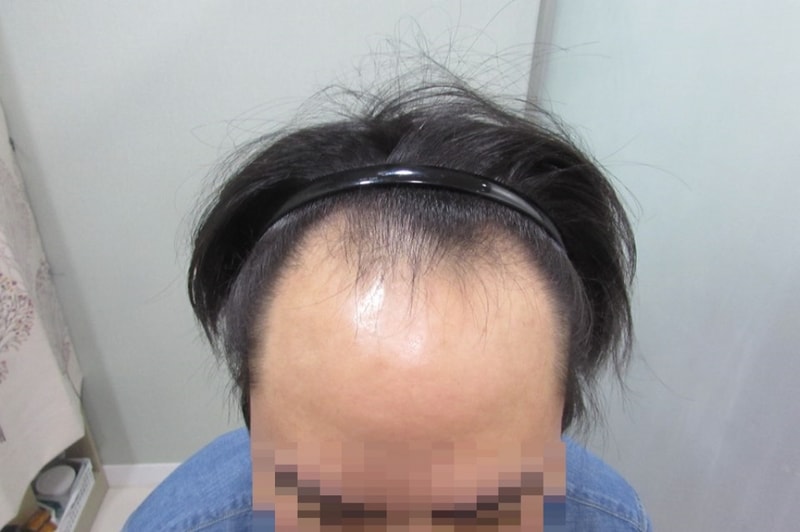 이식 전 (1).jpg