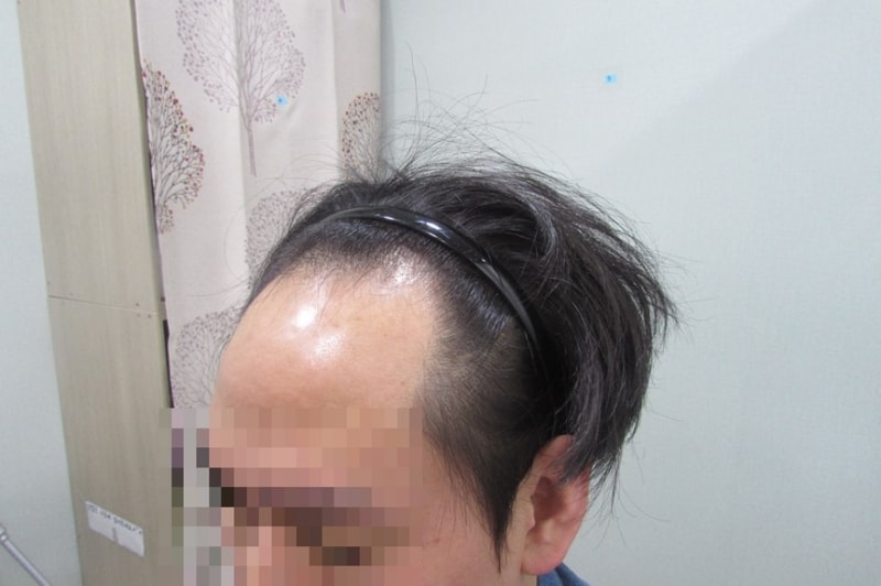 이식 전 (2).jpg