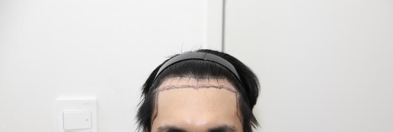 뉴헤어 서울점 절개 모발이식 1800모낭 수술 9개월차 후기입니다.