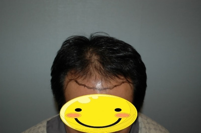 수술전 디자인.jpg