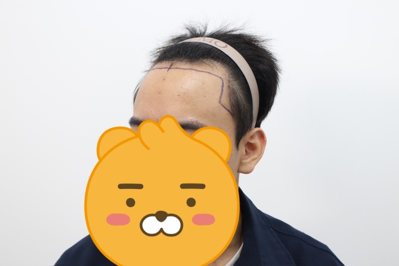 수술전왼쪽.jpg