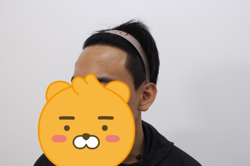 수술후왼쪽.jpg