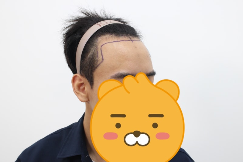 수술전오른쪽.jpg