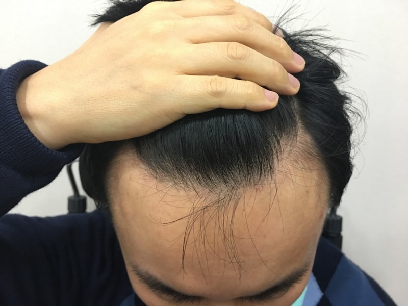 2017년 수술하고 2년3개월 지났습니다.