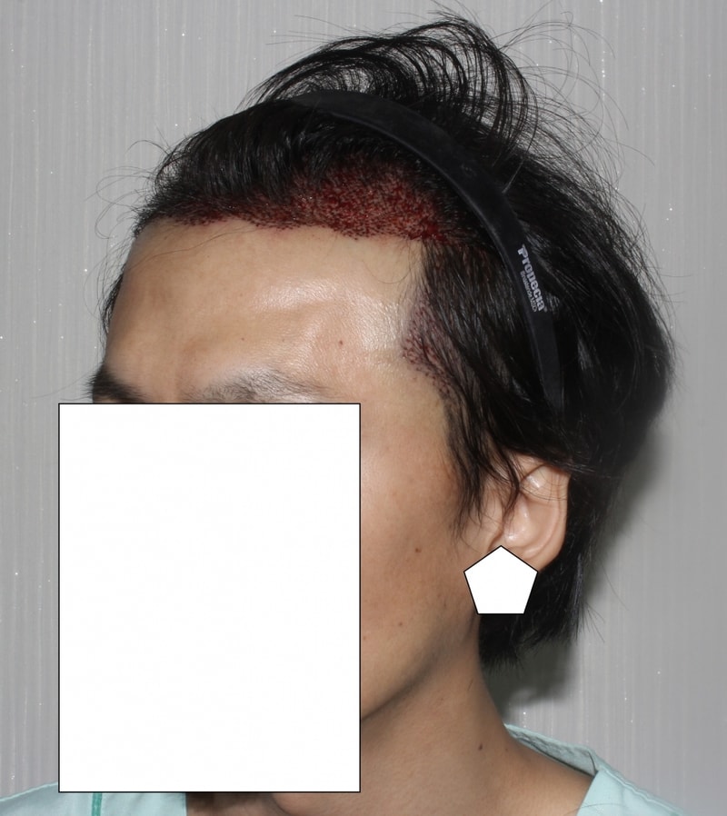 이식후 옆머리.jpg