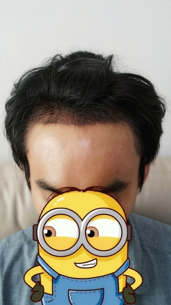 수술3일차윗면.gif