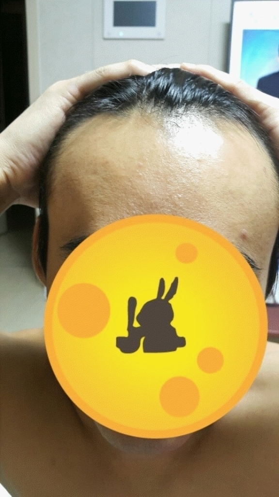 수술전정면.gif