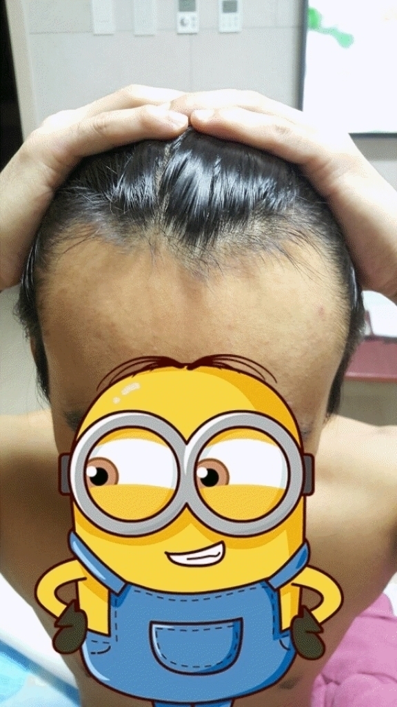 수술전윗면.gif