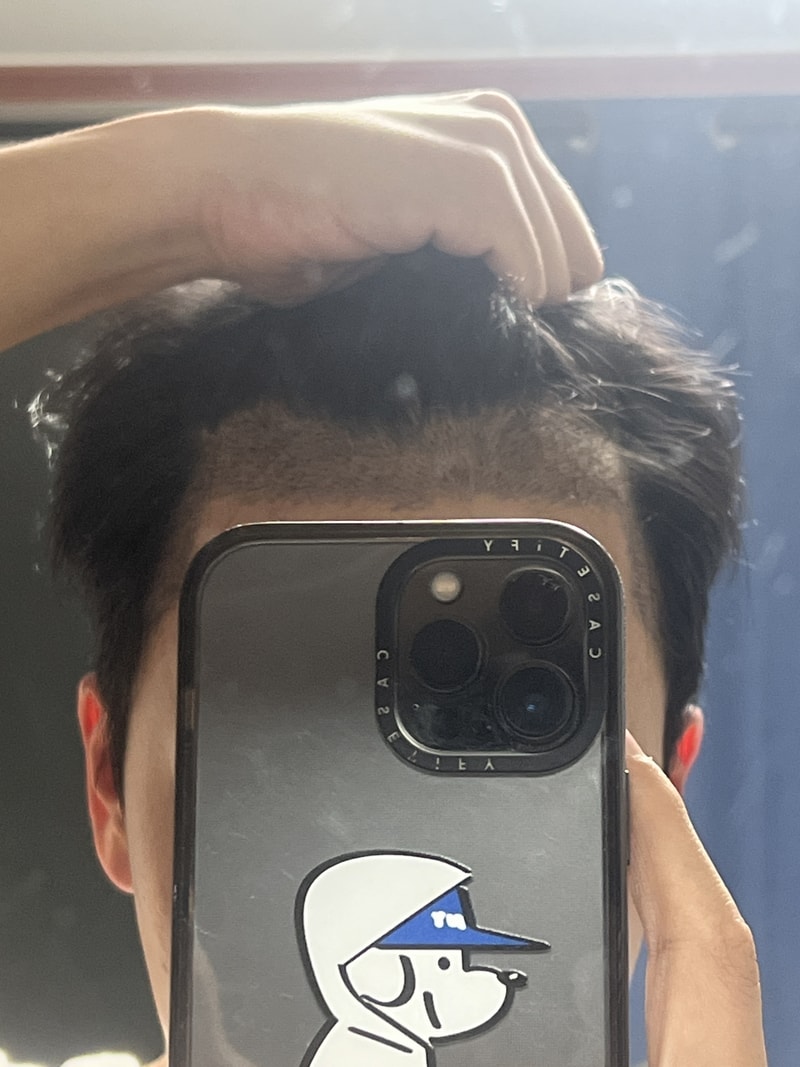 모발이식후기.jpg