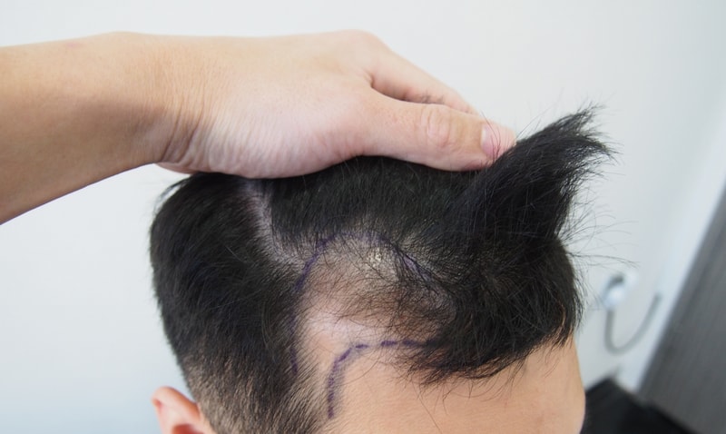 This is the review of 2500 m-shaped non-section surgery on the first day of surgery.