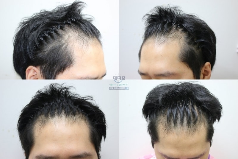 포헤어 수술 1년 지났습니다 평가 한번 부탁드려요