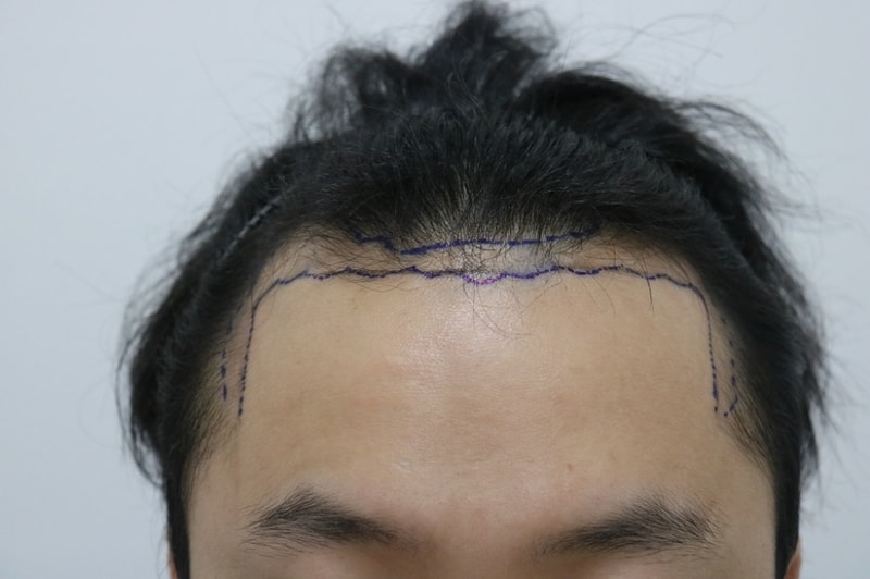 비절개 3000모 7개월 지나는 시점 후기입니다.