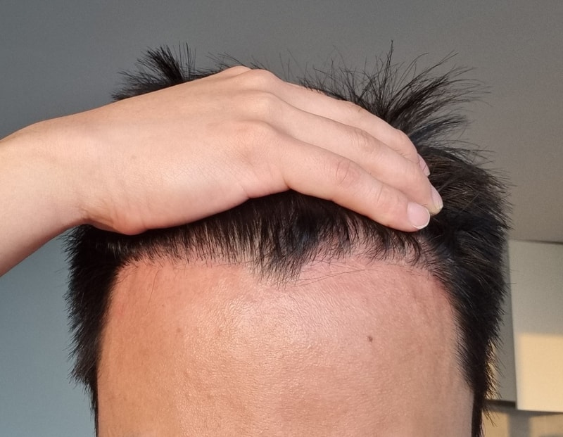 4. 수술후_6개월_셀카_1.jpg